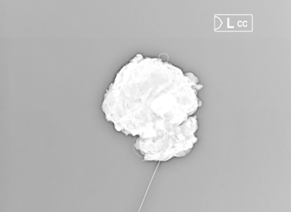 <strong>Figure 1 - Intraoperative specimen of a retrieved clipped node (ycN0) sent for radiological confirmation following wire localization.</strong>