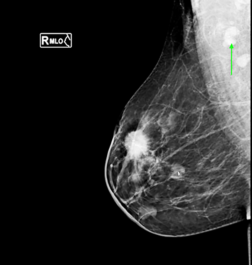 <strong>Figure 2 - Mammogram imaging showing ultrasound-guided clip placement of a pathological right axillary lymph node in a triple-negative breast cancer case</strong>