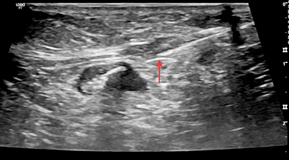 <strong>Figure 3 - Ultrasound image showing clip insertion with needle in a pathological axillary lymph node (cN1) in a female with early breast cancer</strong>