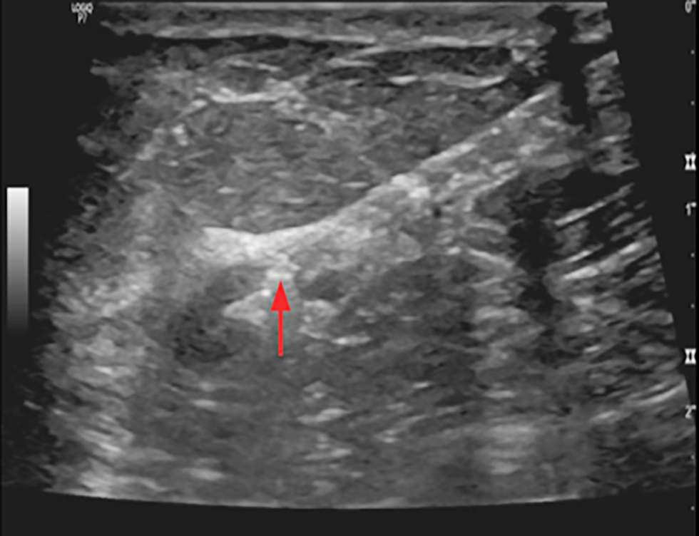 <strong>Figure 4 - Ultrasound imaging shows clip inserted in cortex of pathological axillary LN in a female with early breast cancer CN1</strong>