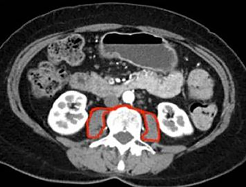 Figure 1 - Total psoas area (TPA) at the level of L3 with both vertebral spines visible