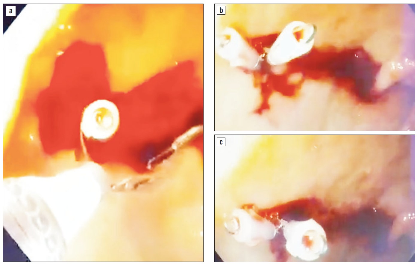 Figure 5 a,b,c,d - Placement of second hemoclip.