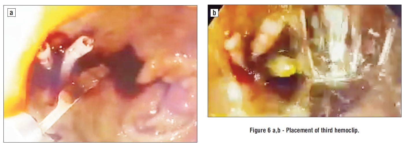 Figure 6 a,b - Placement of third hemoclip.