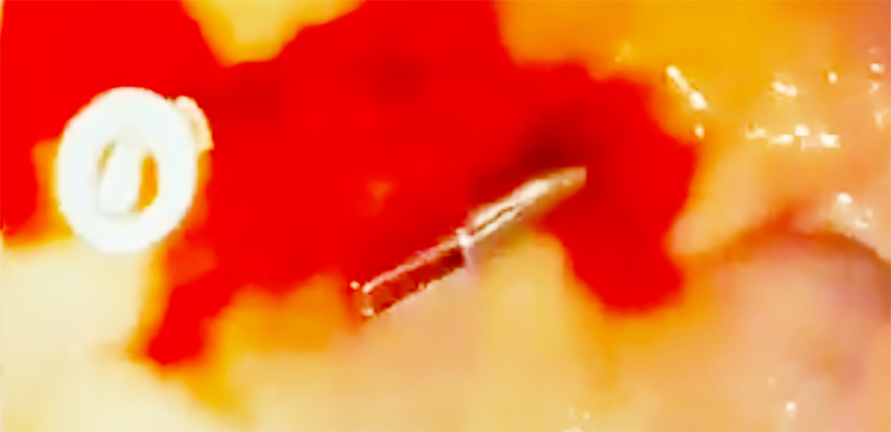 Figure 4 a,b,c - Placement of first hemoclip, one hemoclip failed before.