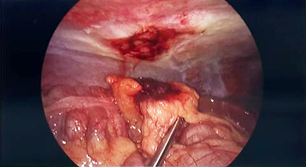 Figure 1 - A segment of infarcted omentum was identified and dense adherence to the anterior abdominal wall which was released during laparoscopic procedure