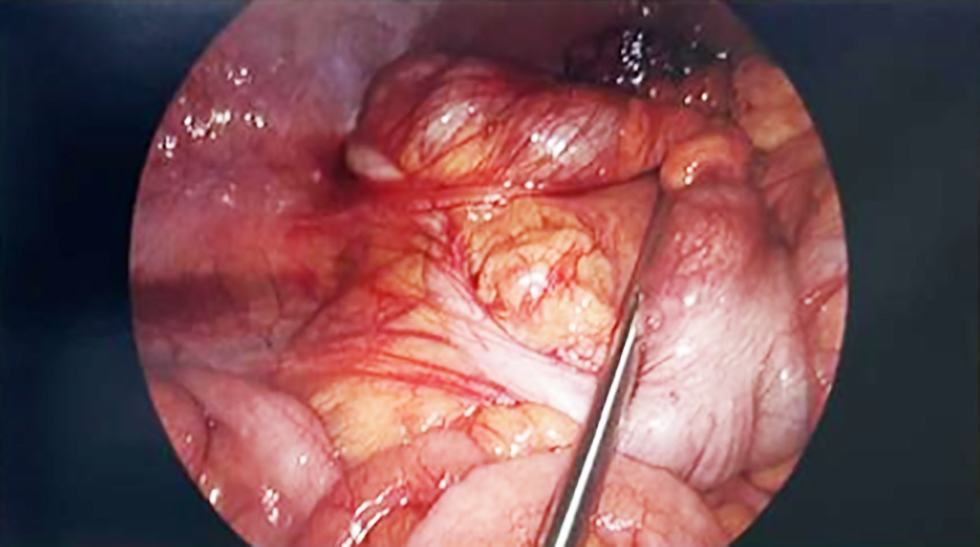 Figure 2 - Laparoscopic view demonstrating a macroscopically normal appendix with no evidence of inflammation, perforation, or surrounding exudate