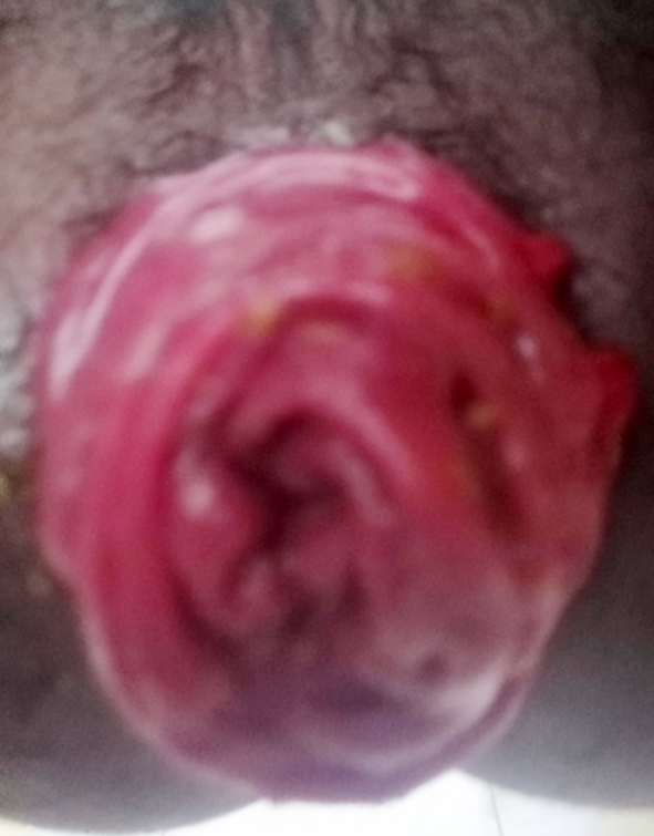 Figure 1 - Clinical image of prolapse recti in this patient