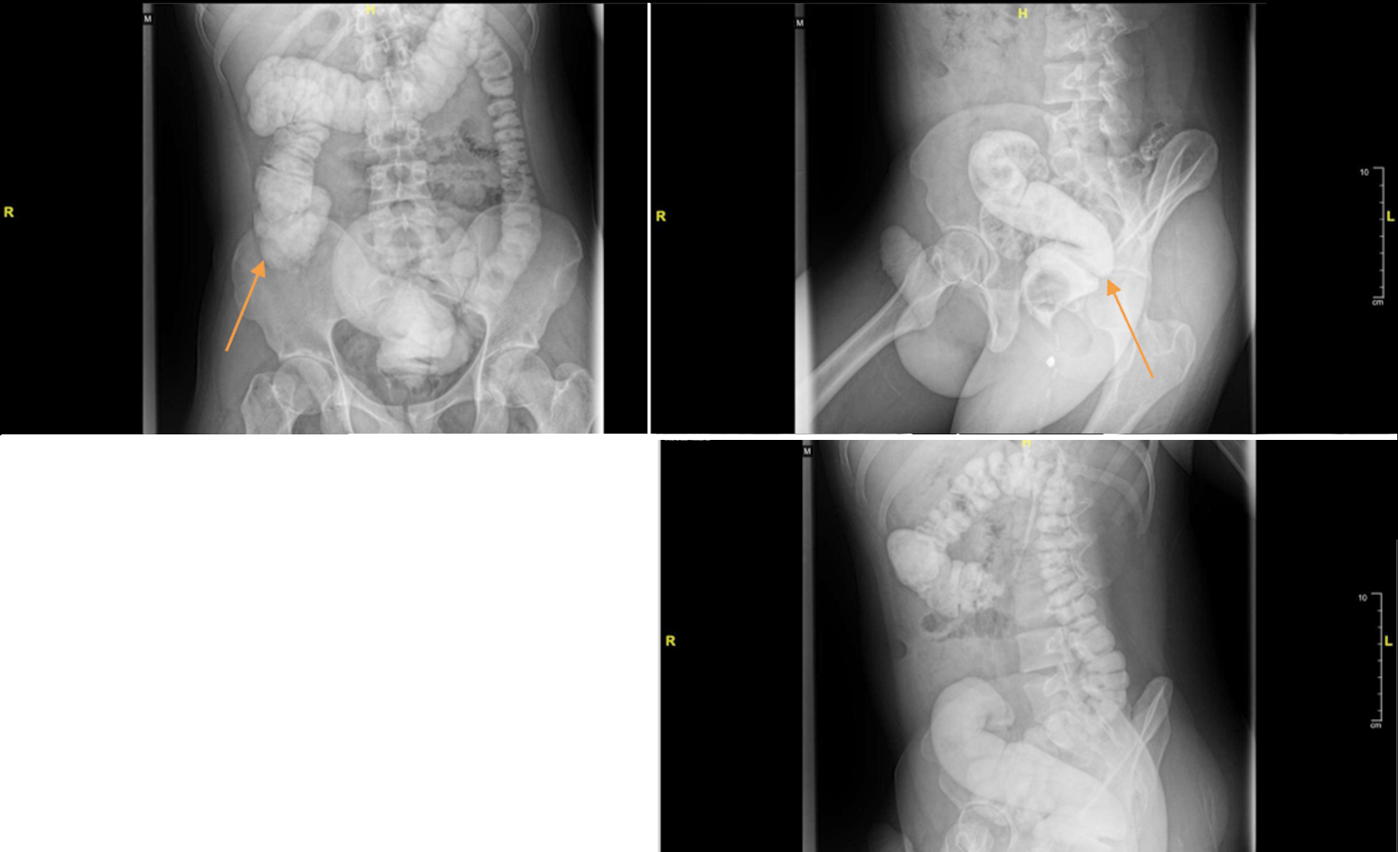 Figure 2 - Barium enema pre-operative (July 2024): redundant ascendence colon, hepatic flexure, and sigmoid with no dilatation of colon