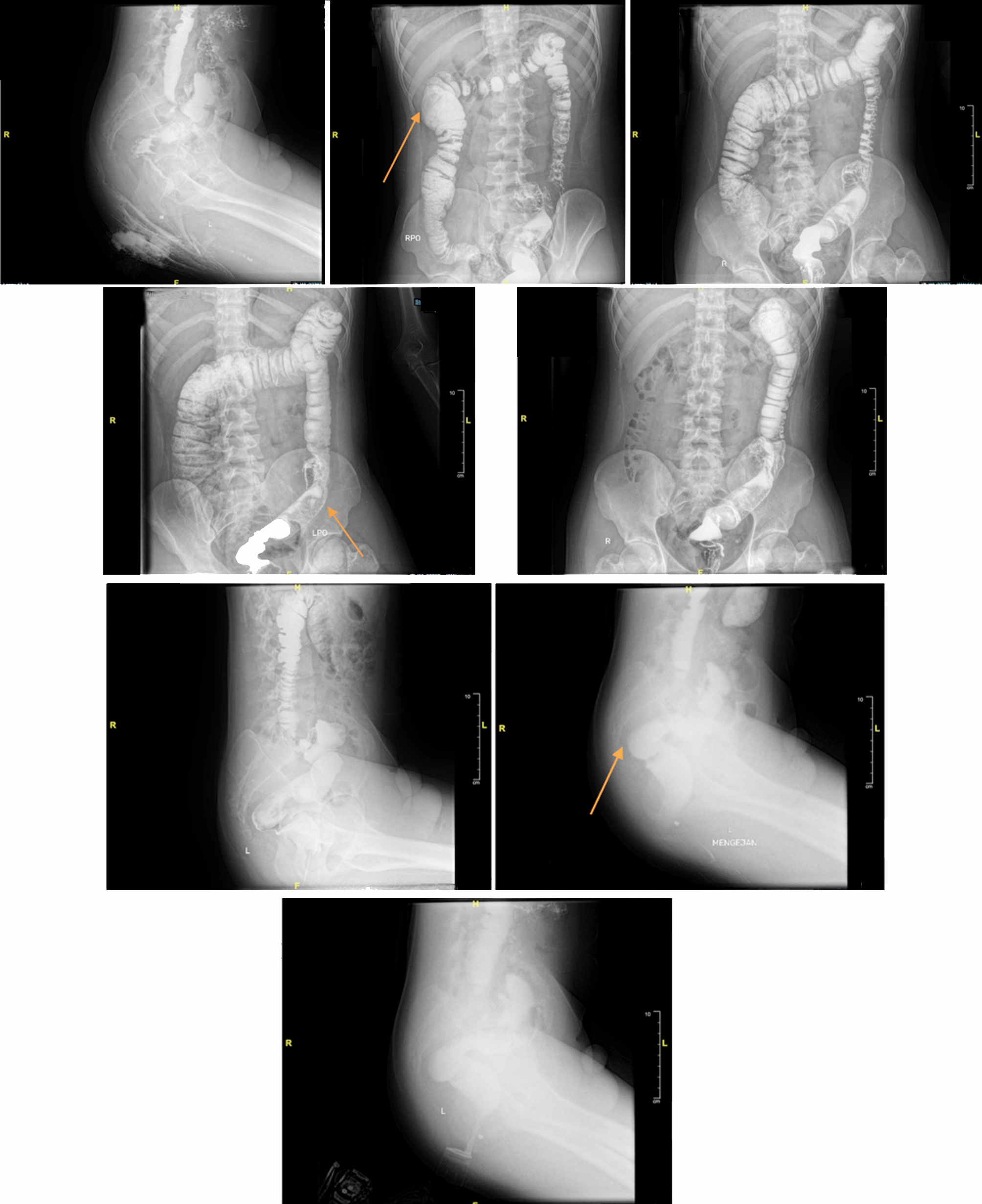 Figure 3 - Barium enema post-operative (September 2024): no stenosis and filling defect on the visualized colon with no visible redundancy of the sigmoid compared to pre-operative (shown with the orange arrow).