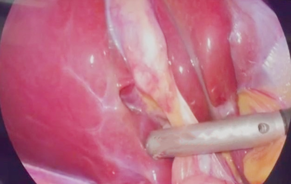 Figure 1 - Intraoperative laparoscopic ultrasonography of the common bile duct. The laparoscopic ultrasound probe is positioned over the hepatoduodenal ligament during laparoscopic cholecystectomy to obtain an ultrasound view of the common bile duct. The surrounding hepatobiliary structures are visualized in the operative field.