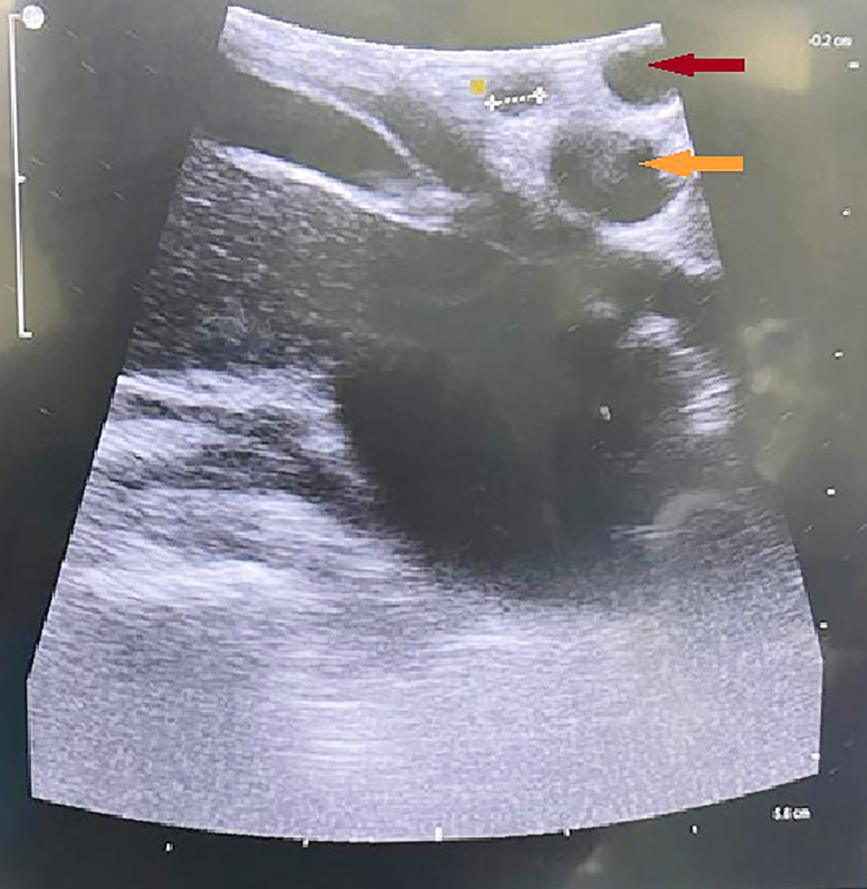 Figure 2 - Radiological evaluation of the common bile duct and measurement of its diameter. The portal vein (orange arrow) is located posteriorly and has been likened to the iconic figure of "Mickey's head," while the hepatic artery  and the common bile duct constitute the anteriorly positioned right and left "ears," respectively.