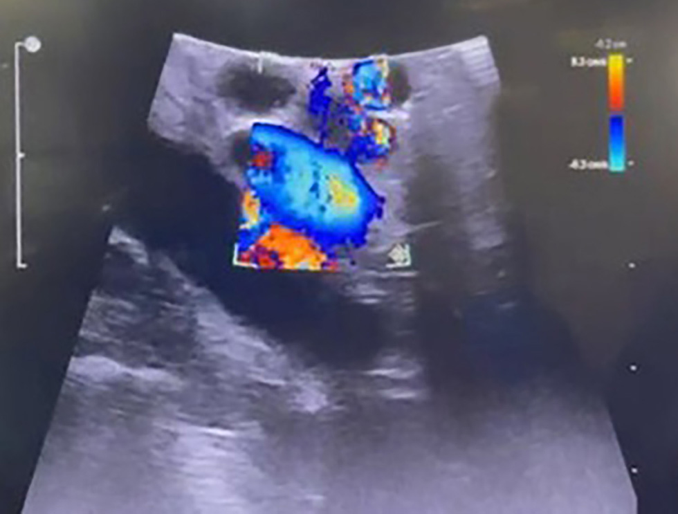 Figure 3 - Doppler function to distinguish the portal vein and hepatic artery from the common bile duct. The portal vein and hepatic artery (which exhibit flow, blue coloration) were readily distinguished from the common bile duct (yellow arrow), which lacks internal flow.