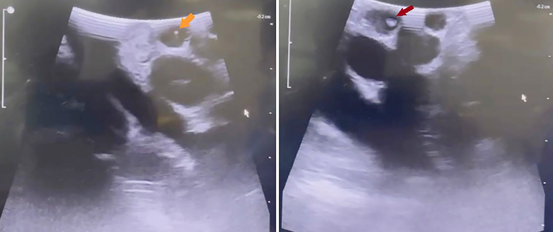 Figure 4 - (a) Small stone (orange arrow) < 4 mm in size detected in the common bile duct. (b) Large stone (red arrow) > 4 mm in size detected in the common bile duct.