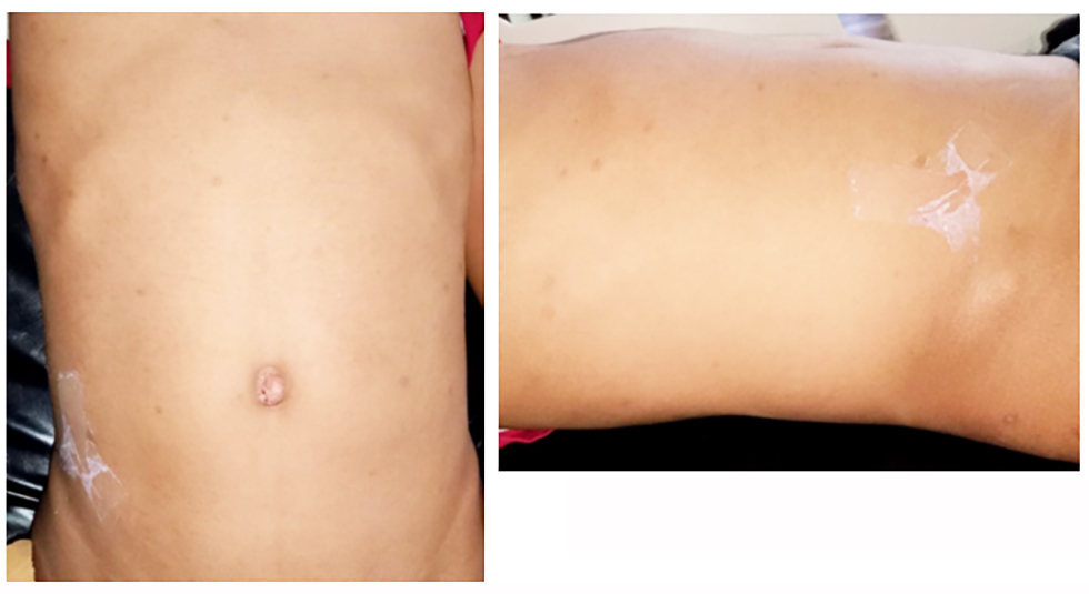 Figure 1 - Clinical Abdominal Photograph 