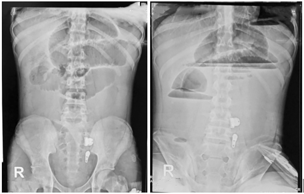 Figure 2 - Abdominal X-ray 