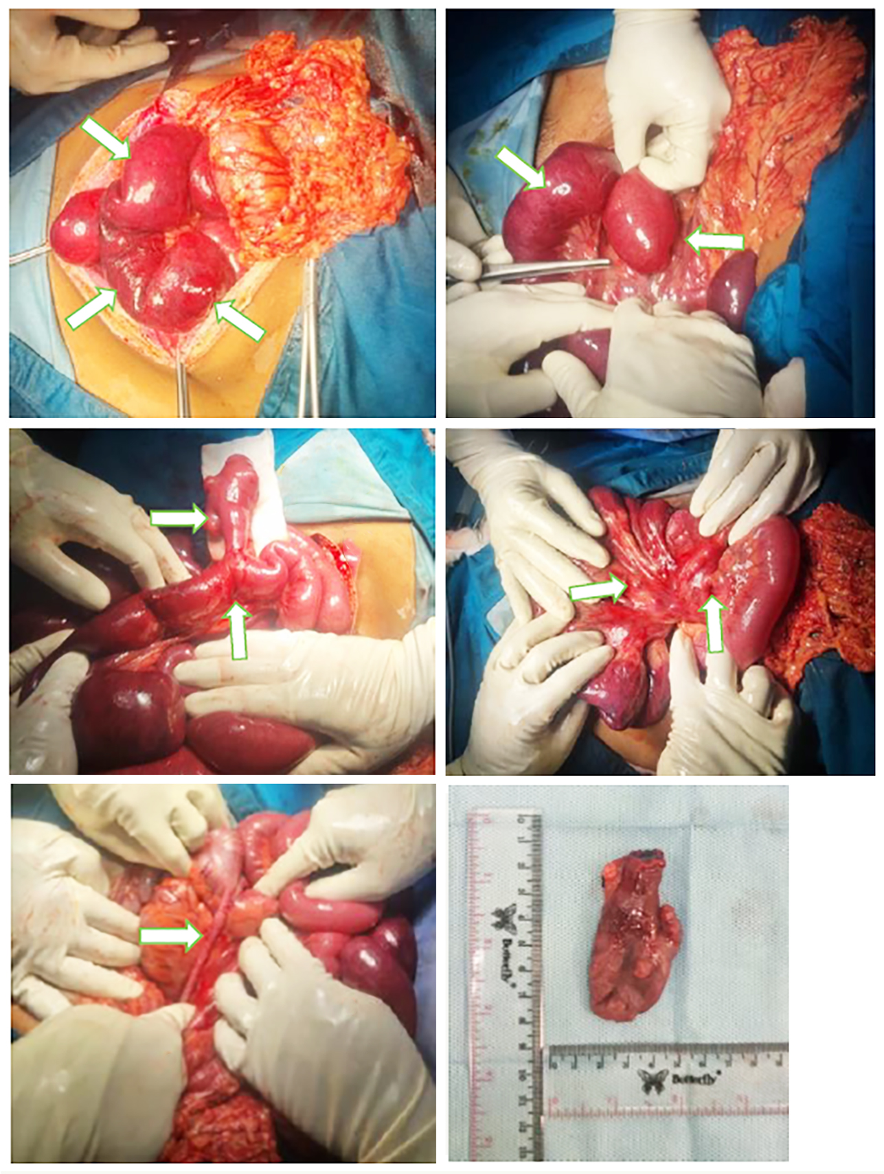 Figure 3 - Intraoperative photographs from exploratory laparotomy.