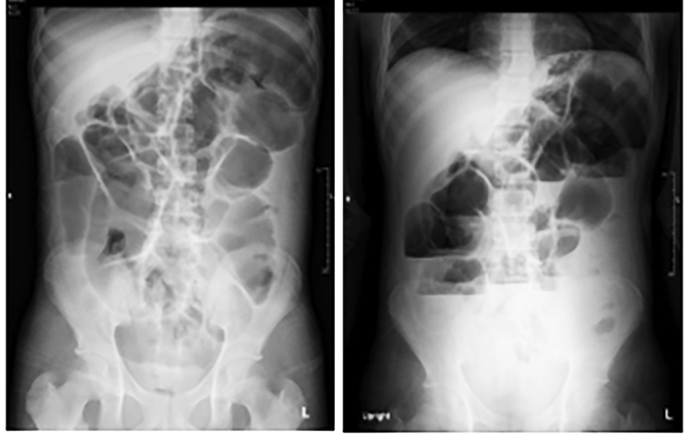 Figure 4 - Follow-up Abdominal X-ray 