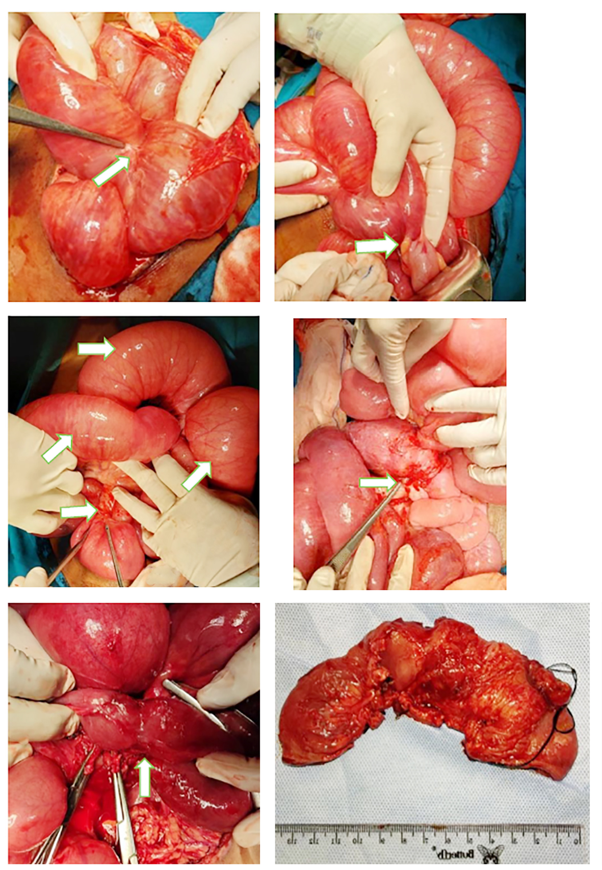 Figure 5 - Intraoperative photographs from re-exploratory laparotomy. (a) grade 3-4 adhesions between ileal loops, with evidence of healing from a previous ileal hematoma; (b) grade 3-4 adhesions between the ileum and sigmoid colon; (c) dilated ileum at adhesion sites; (d, e) fibrotic tissue at the previous wedge excision site forming an 8 cm ileal stricture; (f) a 14 cm ileal segment was resected, including the stricture portion