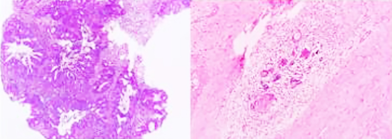 Figure 2 - Histopathological images before and after neoadjuvant chemoradiotherapy in a patient with mid-rectal adenocarcinoma. (a) Preoperative biopsy showed moderately differentiated adenocarcinoma. Tumor cells have large nuclei, basophilic cytoplasm, narrow cytoplasm, and are arranged in a tubular glandular invading the stroma