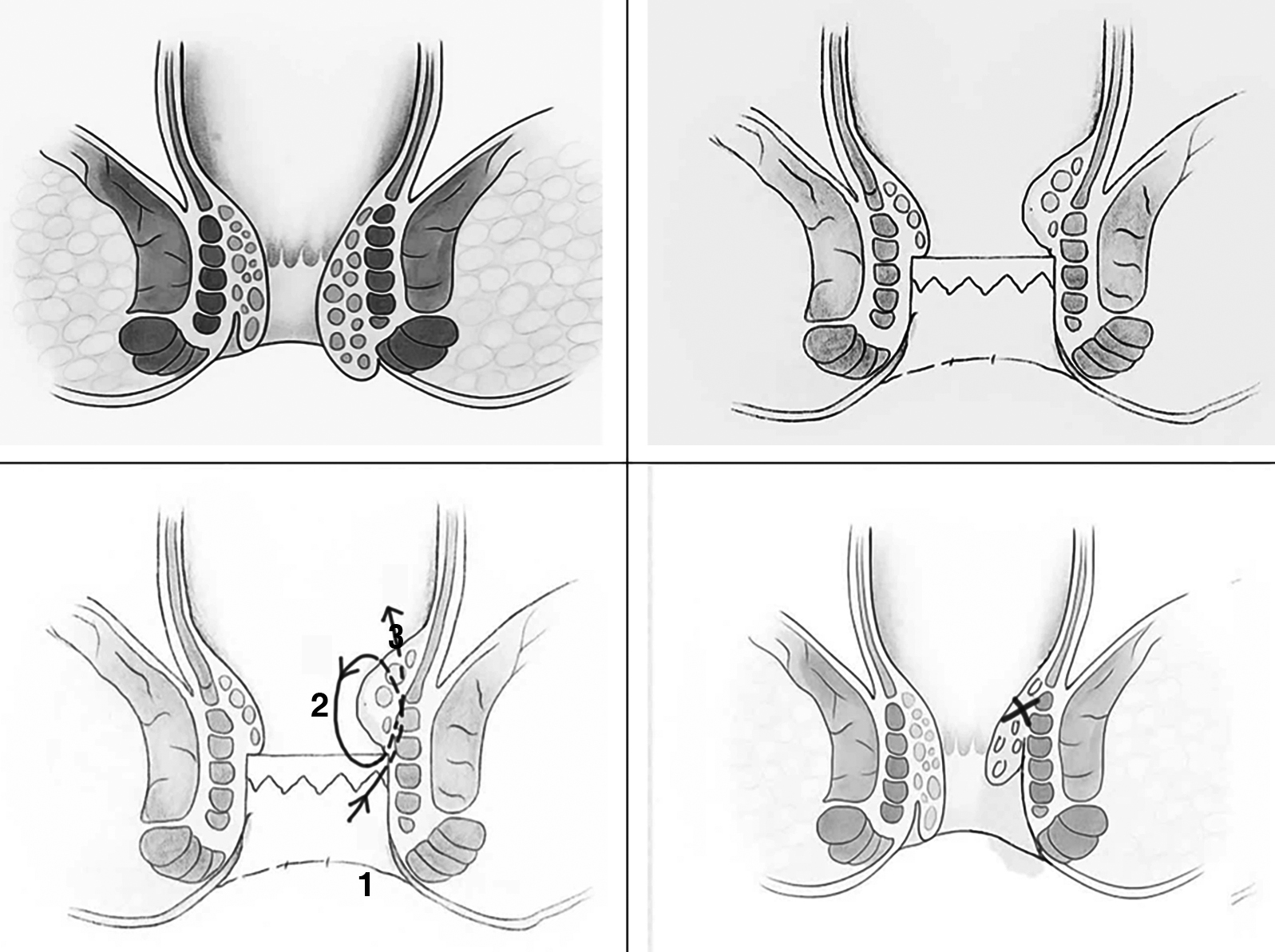 <strong>Figure 1 - TVLM Technique: (a) Hemorrhoidal bundle before surgery; (b) Placement of CAD to protect the dentate line; (c) Vertical ligation-mucopexy of the hemorrhoidal bundle; (d) Postoperative appearance of the hemorrhoidal bundle.</strong>