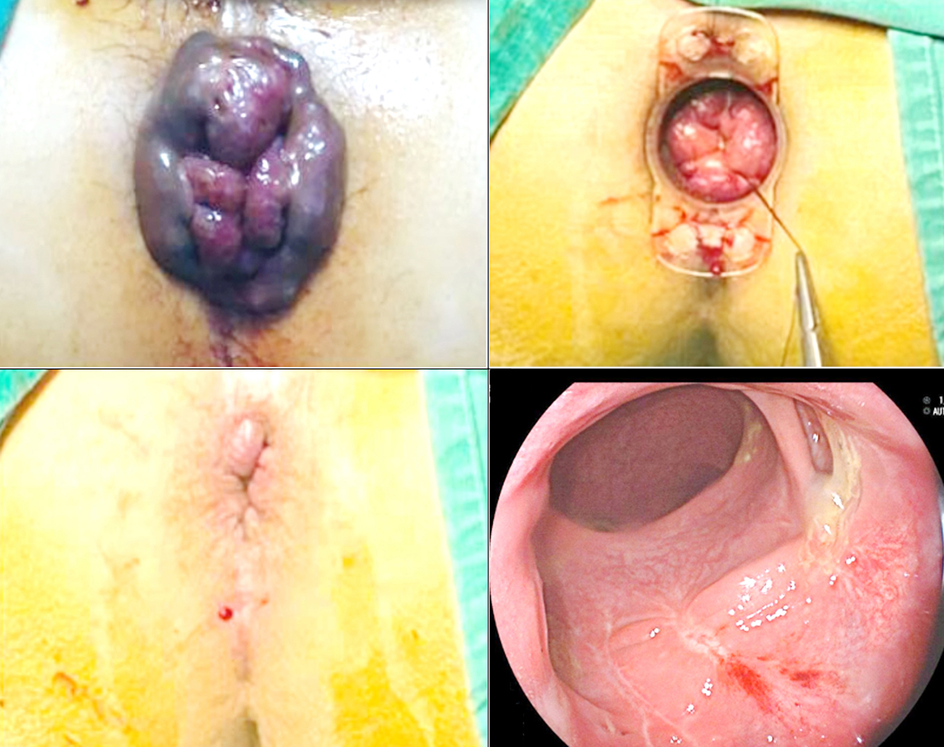 <strong>Figure 2 - Intraoperative and Postoperative Images of TVLM: (a) Preoperative image; (b) Intraoperative image; (c) Postoperative image; (d) Rectoscopy result at 6-month follow-up.</strong>