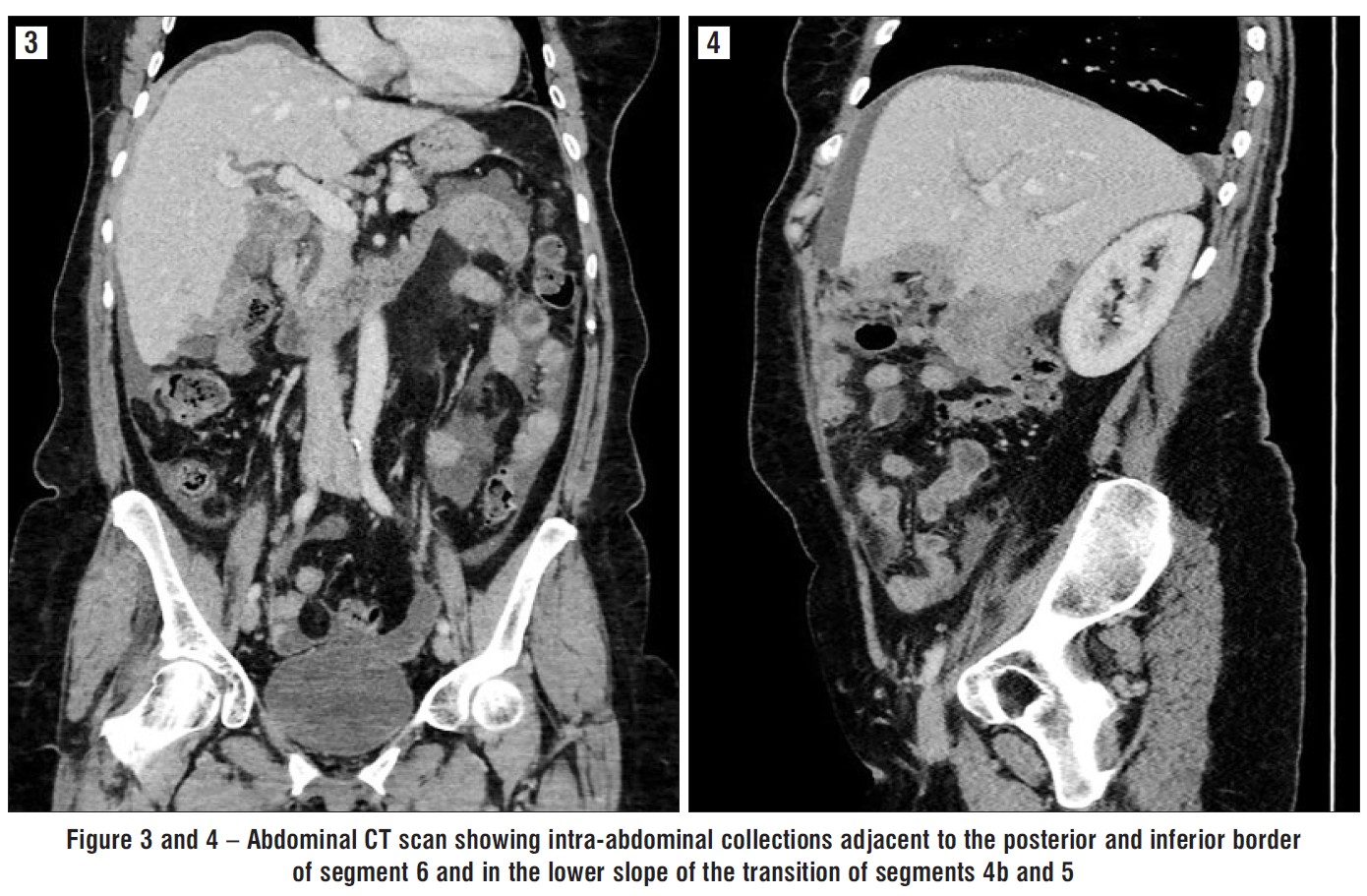 Figure 3 and 4 – Abdominal CT scan showing intra-abdominal collections adjacent to the posterior and inferior border of segment 6 and in the lower slope of the transition of segments 4b and 5