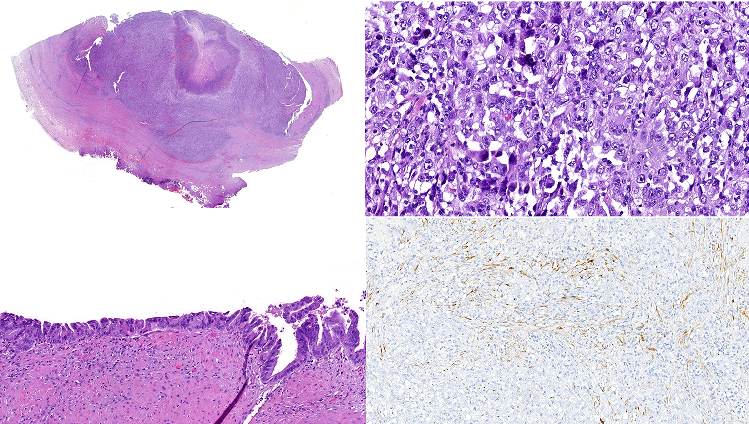 Figure 6 – Histological examination exhibiting a neoplasia infiltrating the gallbladder wall (a: H&E; low power).  Sarcomatoid carcinoma with epithelioid cell morphology and pleomorphic nuclei (b: H&E; 200x) exhibiting focal cytokeratin expression (d: CK8/18 100x). Dysplasia was identified in the adjacent mucosa (c: H&E; 100x)