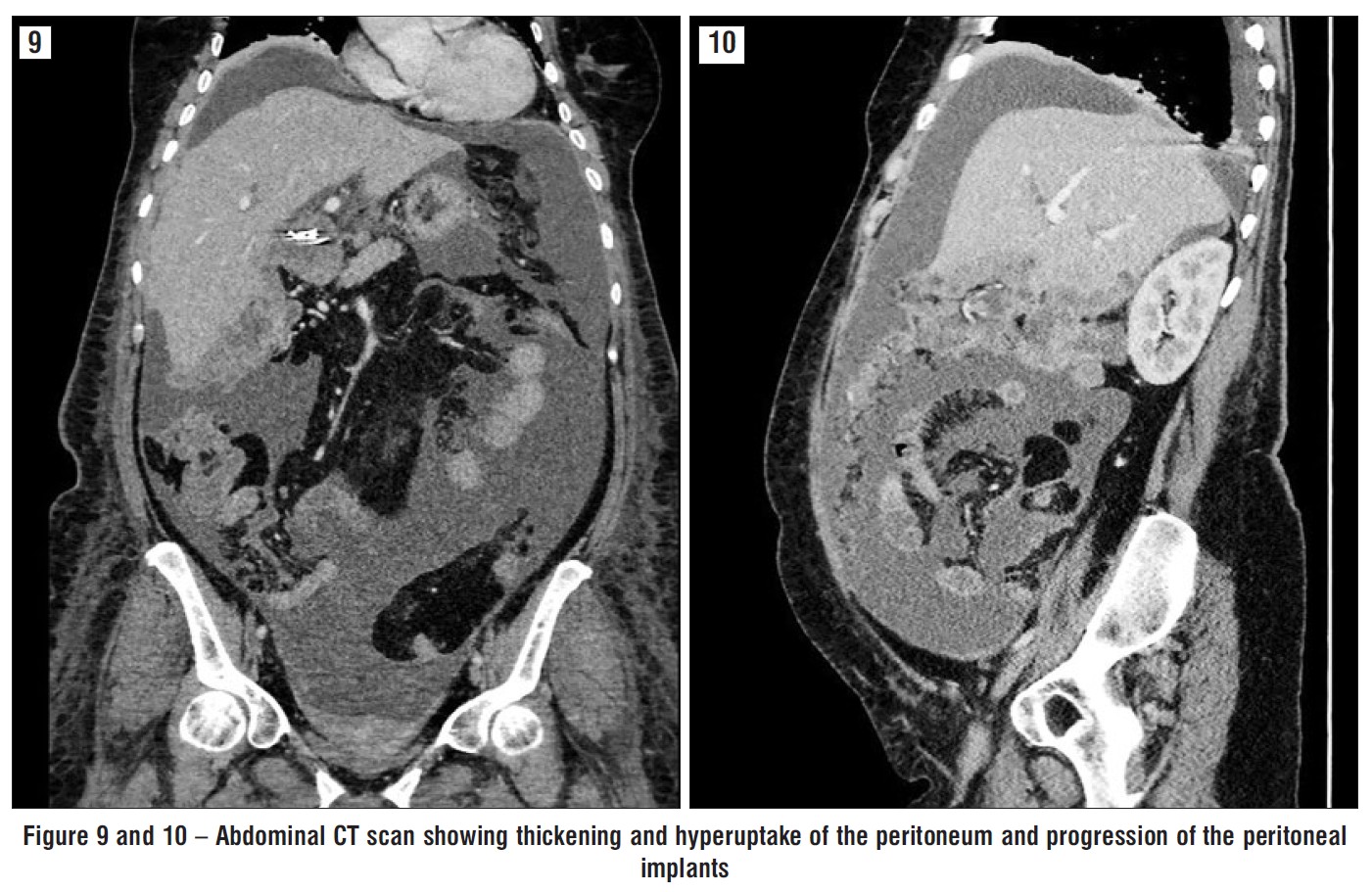 Figure 9 and 10 – Abdominal CT scan showing thickening and hyperuptake of the peritoneum and progression of the peritoneal implants