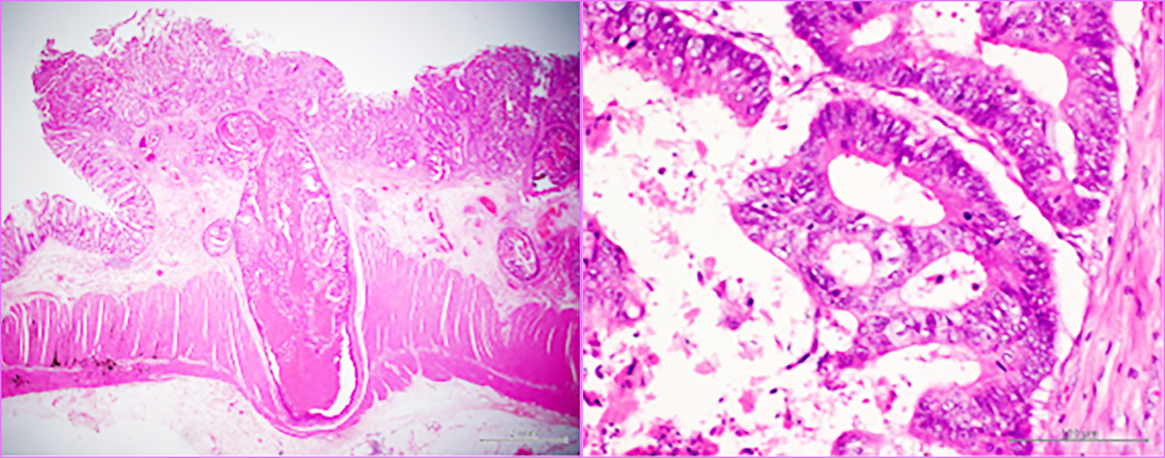 <strong>Figure 1 - Pathological examination of the primary resected specimen.</strong>