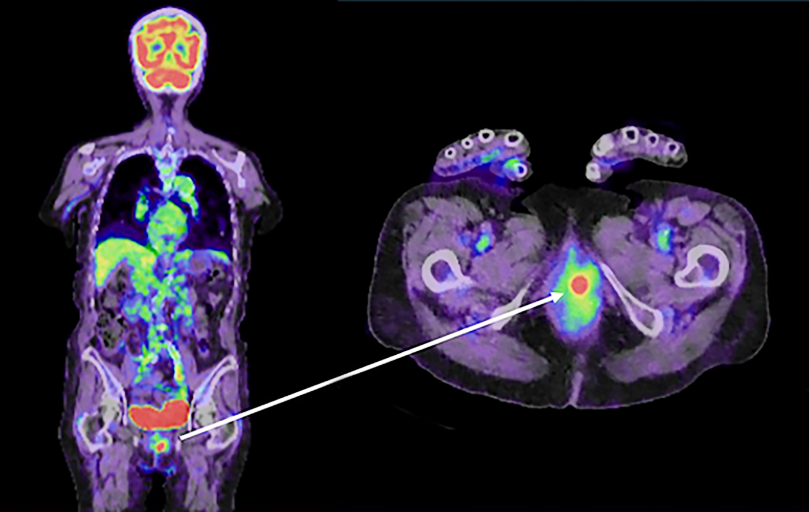 <strong>Figure 2 - PET/CT one year after surgery revealed vaginal metastasis.</strong>