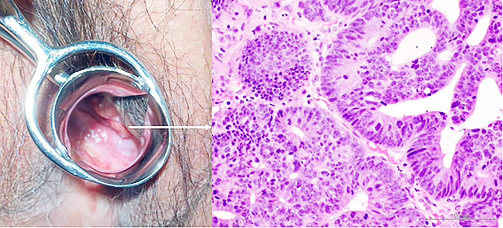 <strong>Figure 3 - Macroscopic and pathological examination of the vaginal lesion.</strong>