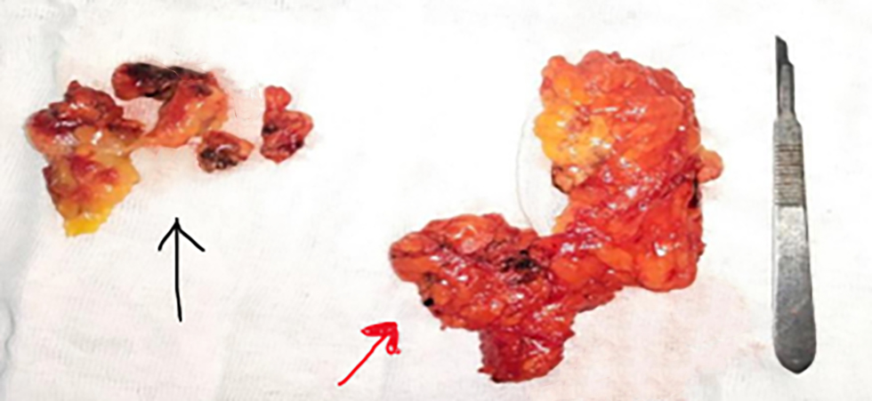 Figure 1 - Black eye identified in 3 lymph nodes and adjacent soft tissue (black arrow), rest of axillary lymph nodes