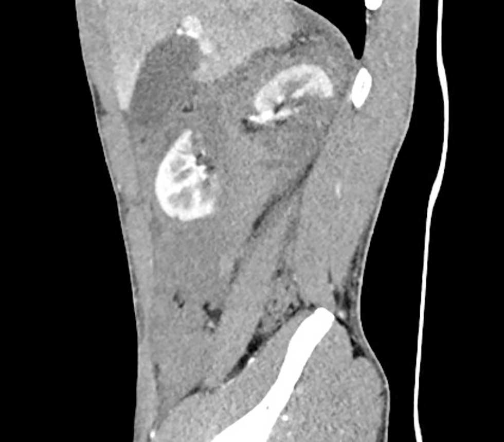 Figure 1 - Contrast-enhanced CT at arterial phase in sagittal plane showing deep laceration of the parenchyma and extensive retroperitoneal heterogenous fluid collection