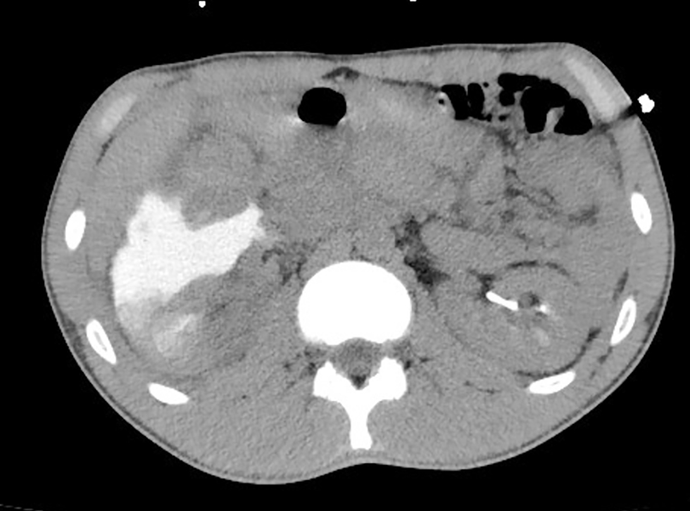 Figure 2 - Contrast-enhanced CT at urographic phase showing right kidney laceration and large amount of contrast extravasation in the retroperitoneal space corresponding to urinoma