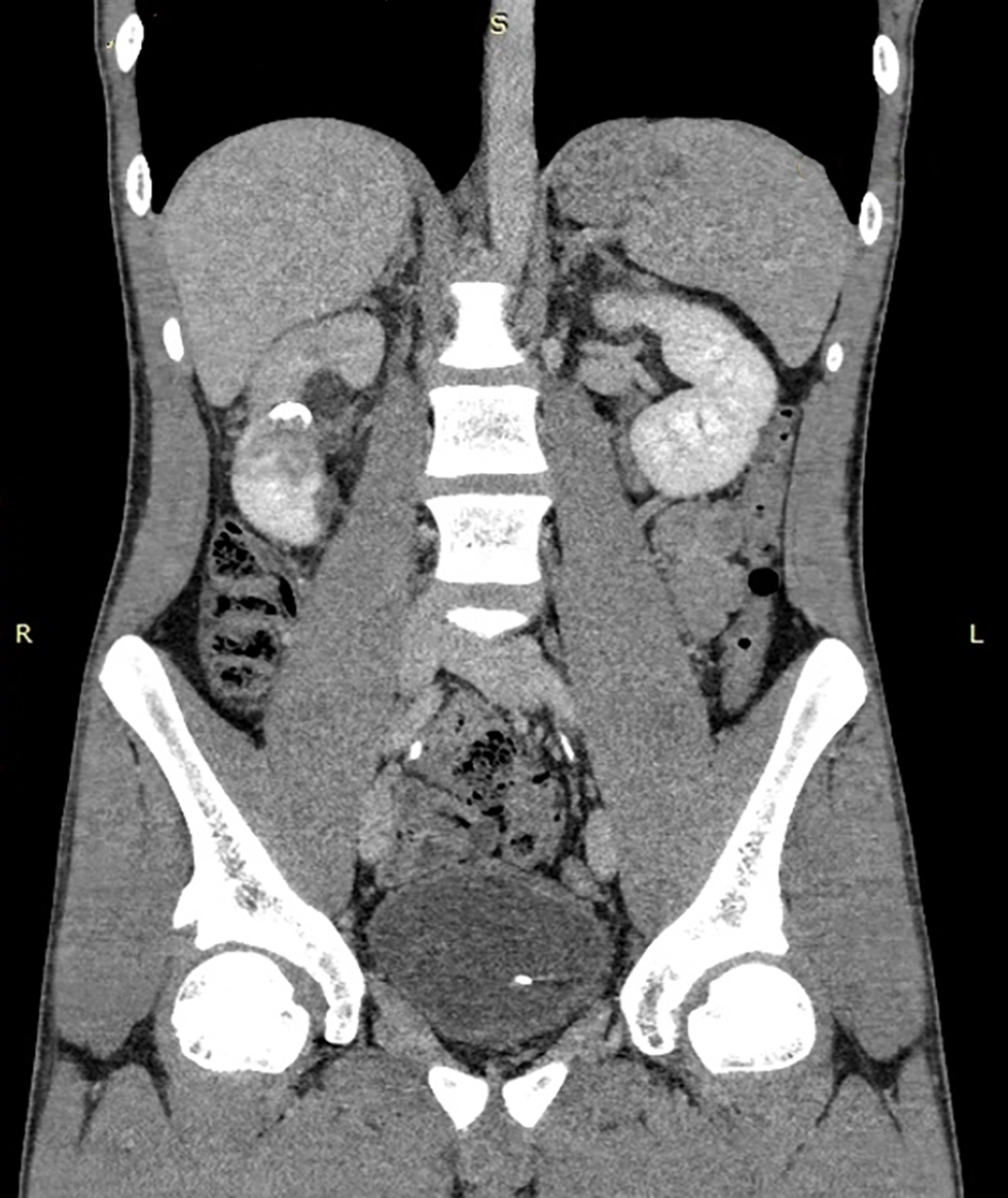 Figure 3 - Follow-up CT urography performed four months after the initial scan. Coronal urographic-phase image demonstrates a right-sided JJ ureteric stent with the proximal pigtail positioned within the right renal pelvis. Hypoenhancement of the upper pole renal parenchyma is noted, associated with dilatation of the upper calyceal system. The previously identified retroperitoneal fluid collections have completely resolved.