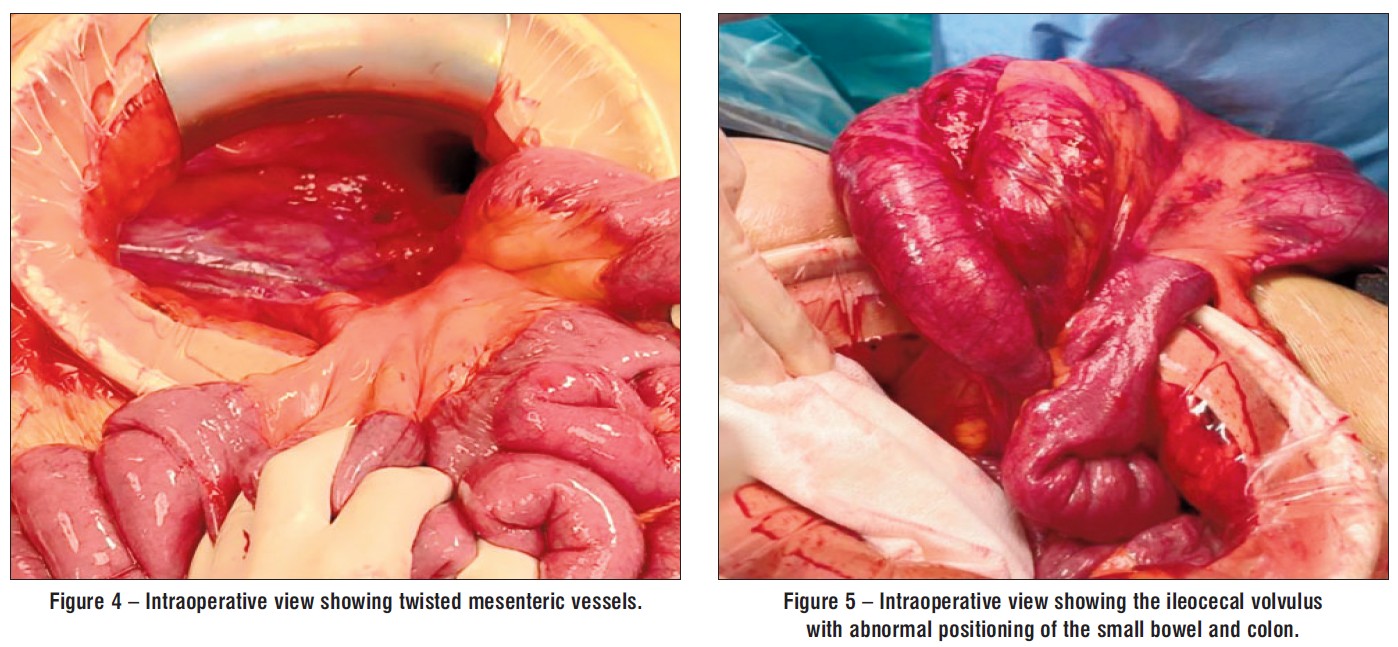 <strong>Figure 4 – Intraoperative view showing twisted mesenteric vessels.</strong>