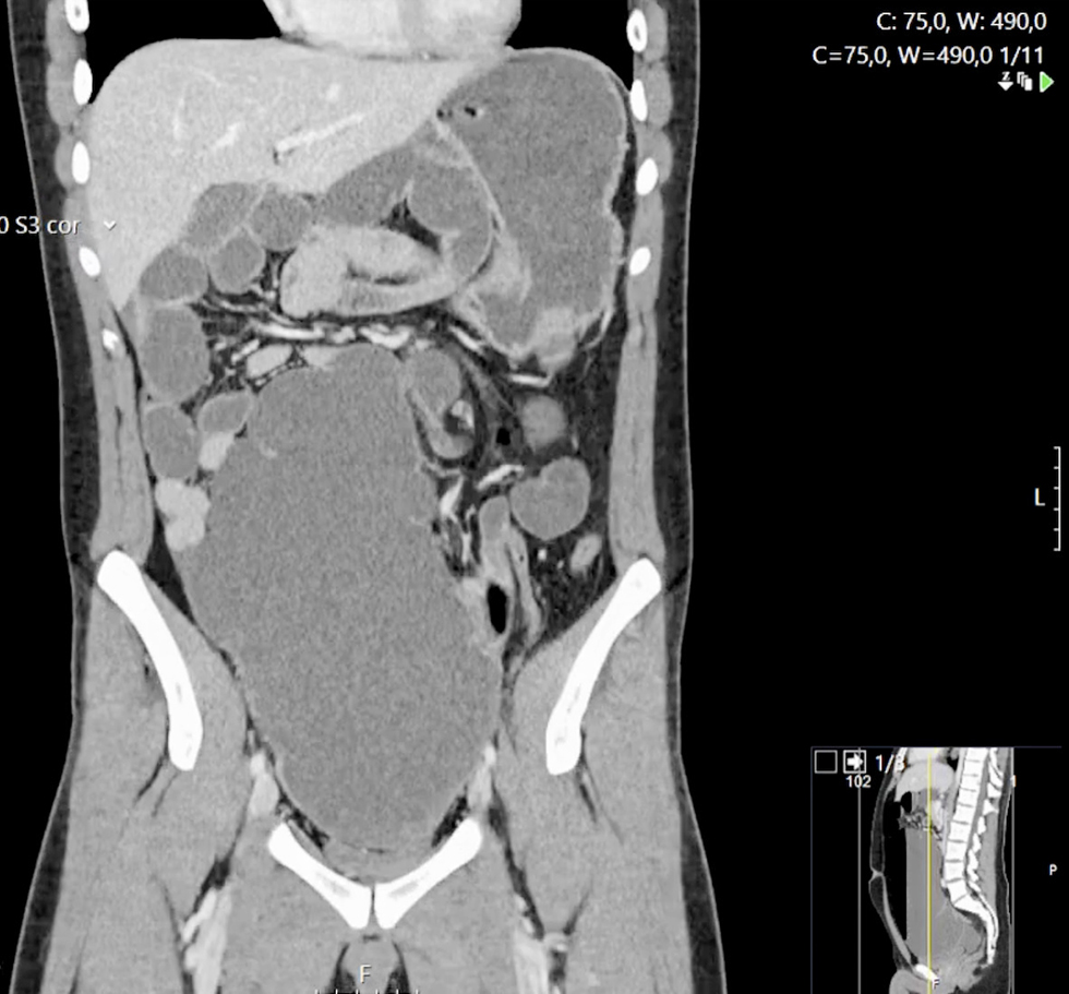 <strong>Figure 1 - Coronal CT image showing significant cecal distension and the ‘whirlpool sign’ due to twisted mesenteric vessels, suggestive of midgut volvulus.</strong>