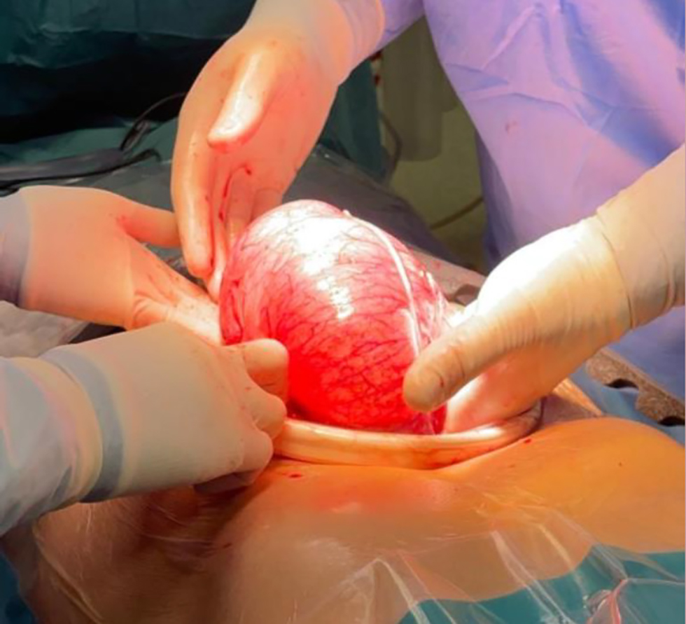 <strong>Figure 2 - Intraoperative view demonstrating markedly distended cecum  without ischemia or perforation.</strong>