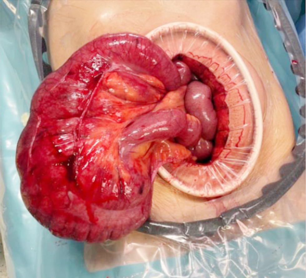 <strong>Figure 3 – Intraoperative view showing the ileocecal volvulus with abnormal positioning of the small bowel and colon.</strong>