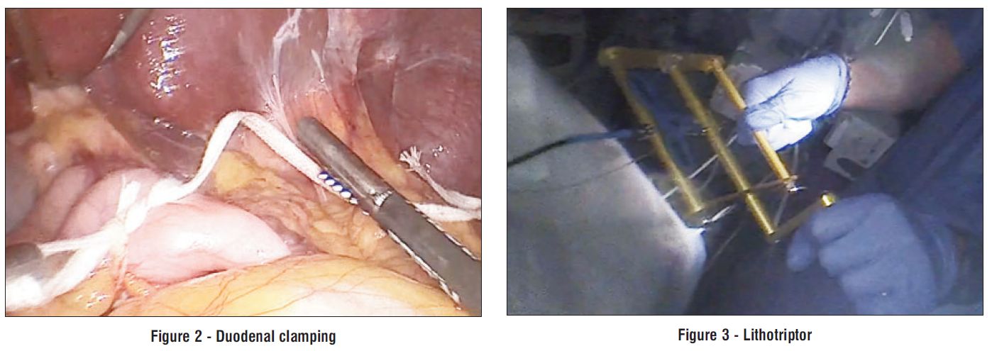 Figure 3 – Lithotriptor