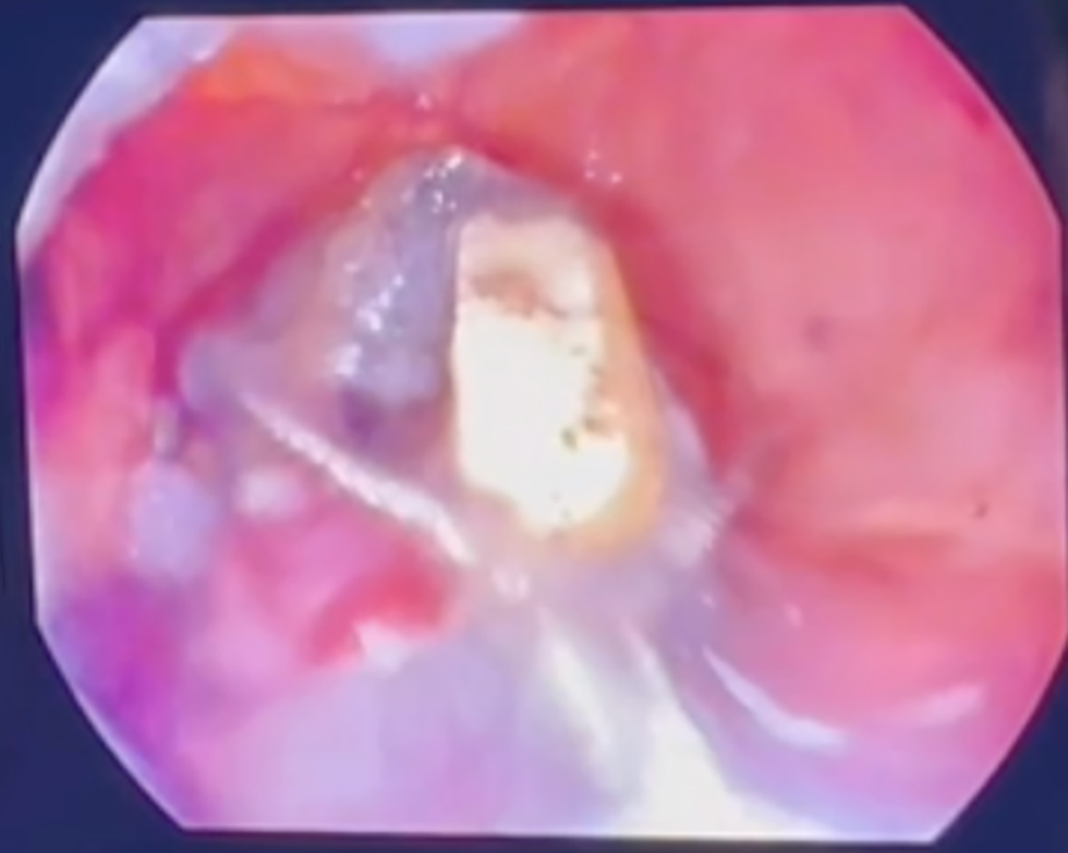 Figure 4 - Endoscopic band removal
