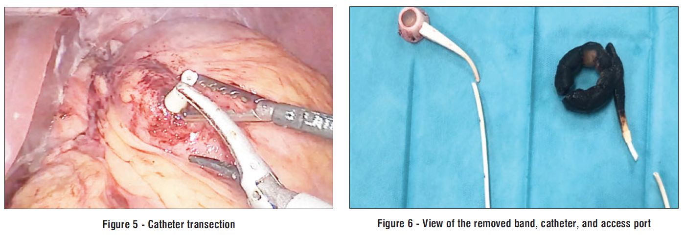 Figure 6 - View of the removed band, catheter, and access port