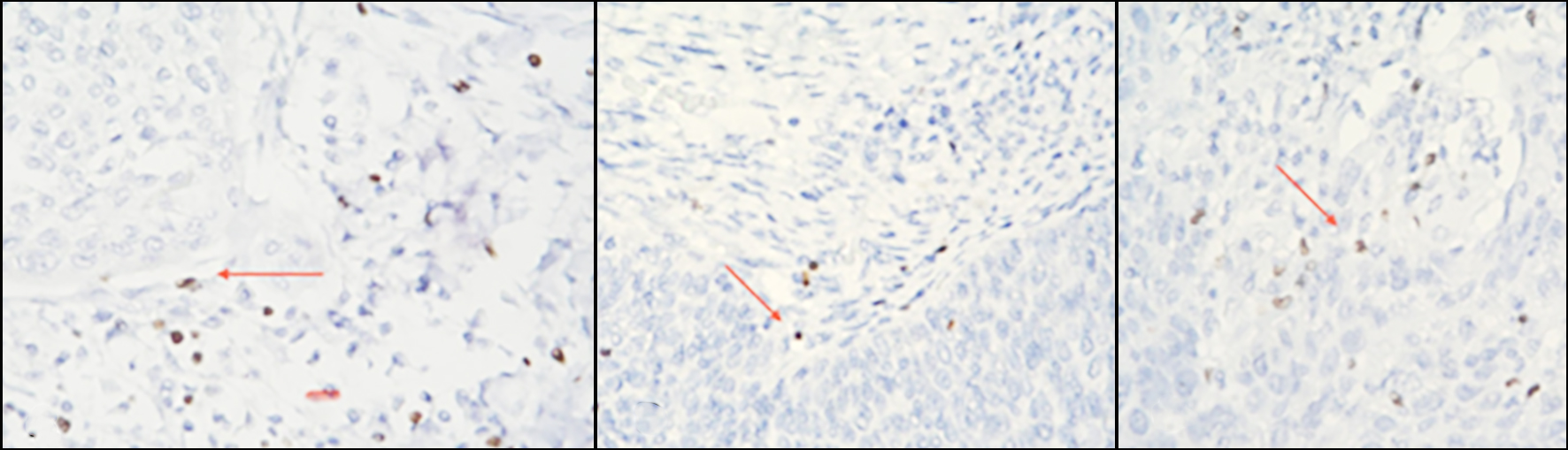 <strong>Figure 2 - Microscopic evaluation of IHC- stained FOXP3+ T cells (colored brownish) in CC: absent (a); low (b) and high (c) intratumoral infiltration of positive cells (red arrow).</strong>