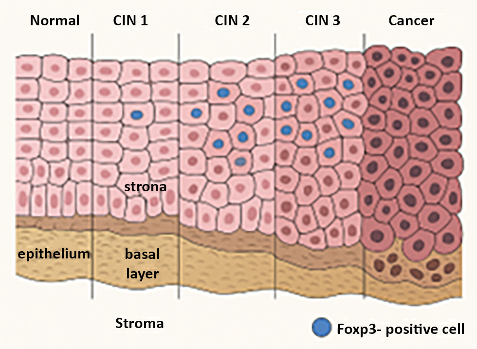 <strong>Figure 3 - Foxp3 expression in cervical cancer </strong>