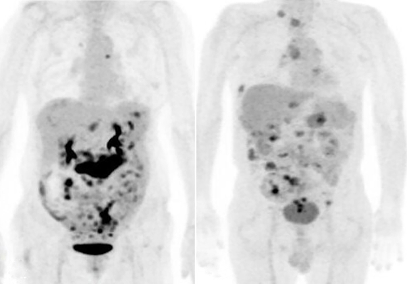 Figure 1 - PET scans shows high PCI scores (a) Case 7 with 27 PCI score; (b) Case 10 with 23 PCI score