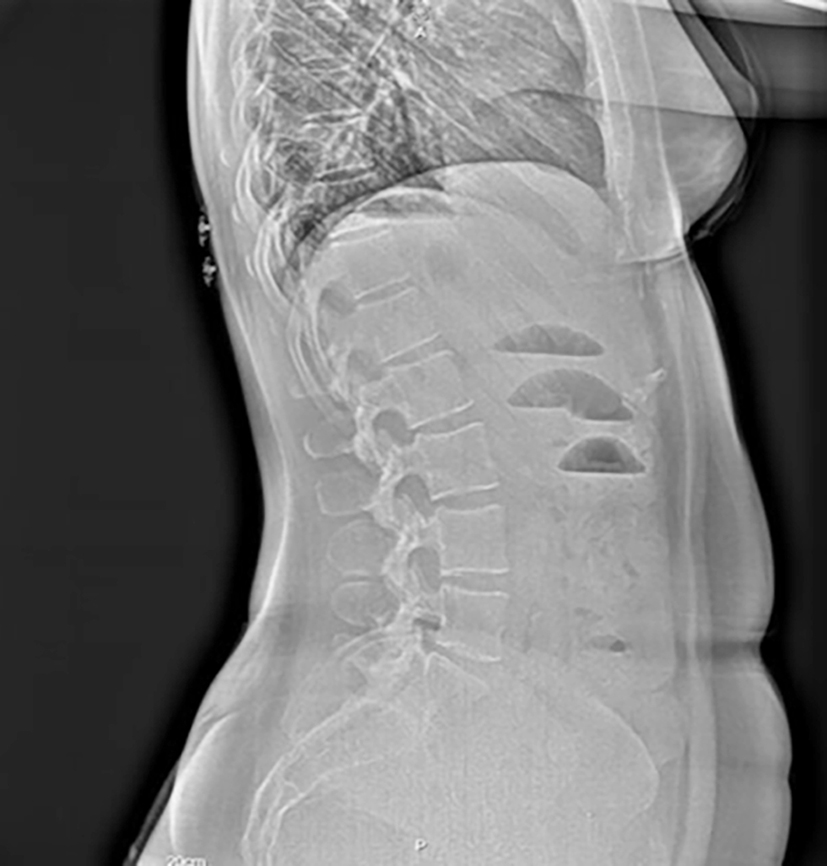 Figure 1 - Lateral abdominal X-ray showing air-fluid levels without significant dilation of the small intestine