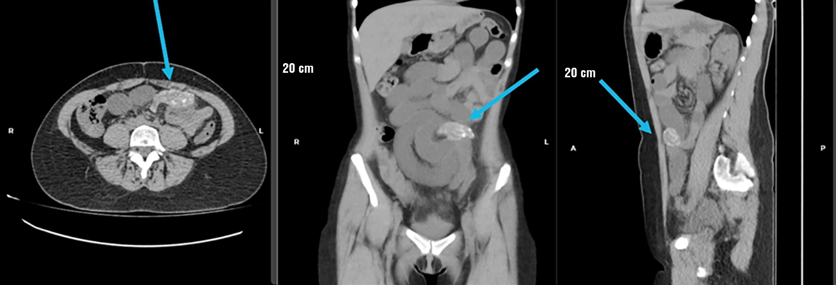 Figure 2 - Simple abdominal computed tomography. (a) Axial view, (b) Coronal view, and (c) Sagittal view. The blue arrow indicates a circumferential tumor lesion in the mesogastric region with internal calcifications
