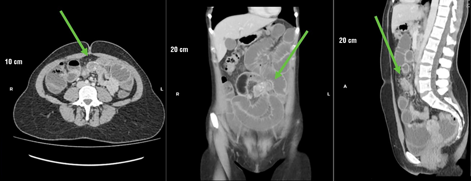 Figure 3 - Contrast-enhanced abdominal computed tomography. (a) Axial view, (b) Coronal view, and (c) Sagittal view. The green arrow shows an oval lesion in the small intestine with significant enhancement, a transition zone, and dilation of the proximal loops