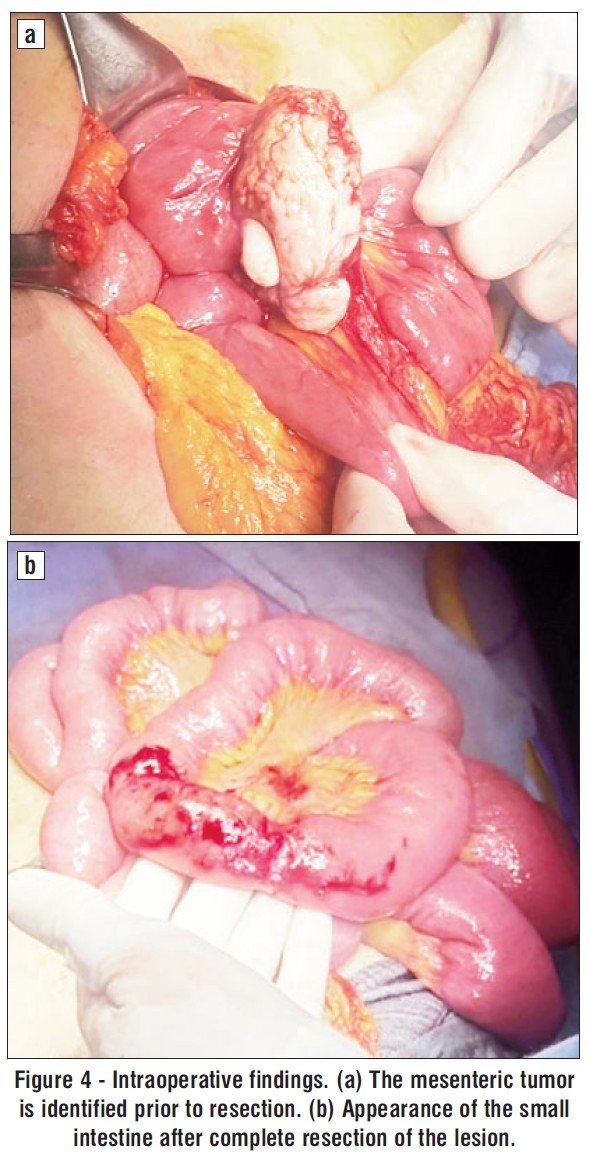 Figure 4 - Intraoperative findings. (a) The mesenteric tumor is identified prior to resection. (b) Appearance of the small intestine after complete resection of the lesion