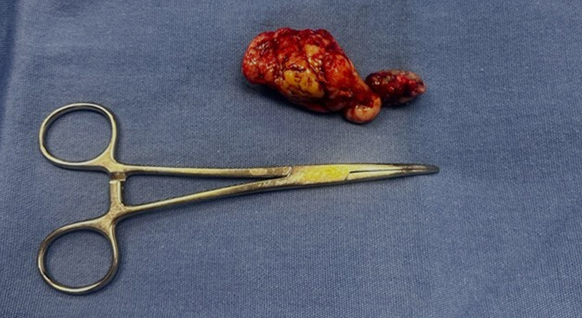 <strong>Figure 5 - Gross surgical specimen. The resected tumor measures 7 x 3 cm and presents a solid, fibrous, and multinodular appearance with a cerebriform surface.</strong>